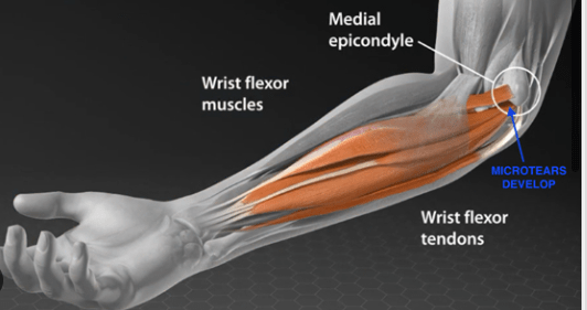 Golfers elbow and CBD